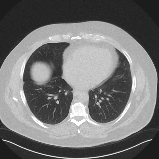Normal HRCT (Radiopaedia 40797-43458 Axial lung window 38).png