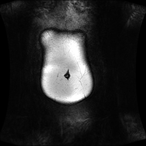 Normal MRI abdomen in pregnancy (Radiopaedia 88001-104541 N 16).jpg