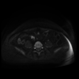 Normal MRI abdomen in pregnancy (Radiopaedia 88005-104548 Axial DWI 104).jpg