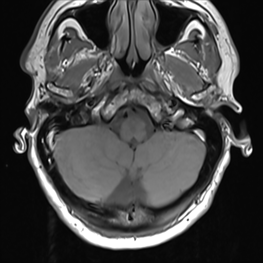 File:Normal MRI cervical spine (infection protocol) (Radiopaedia 53916-60039 Axial 3).png