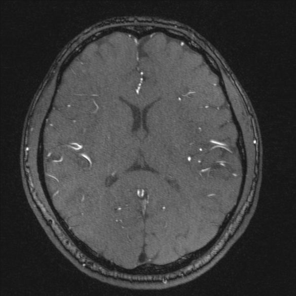 Normal brain MRI including MRA (Radiopaedia 48748-53763 Axial MRA 126).jpg