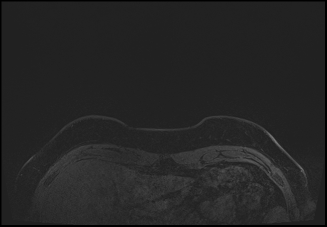 Normal breast MRI - dense breasts (Radiopaedia 80454-93850 C 1).jpg