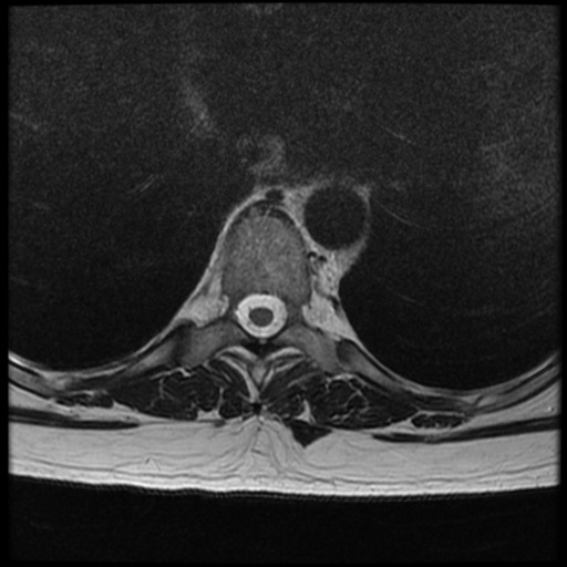 File:Normal cervical and thoracic spine MRI (Radiopaedia 35630-37156 H 19).png