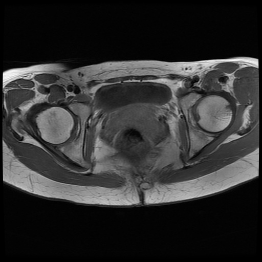 File:Normal female pelvis MRI (retroverted uterus) (Radiopaedia 61832-69933 Axial T1 22).jpg