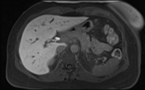 File:Normal hepatobiliary phase liver MRI (Radiopaedia 58968-66230 A 40).jpg
