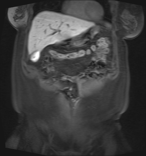 File:Normal hepatobiliary phase liver MRI (Radiopaedia 58968-66230 B 40).jpg