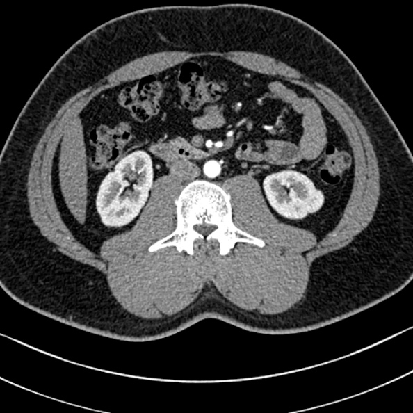 Normal kidneys on 4-phase CT study (Radiopaedia 25889-26038 B 59).jpg