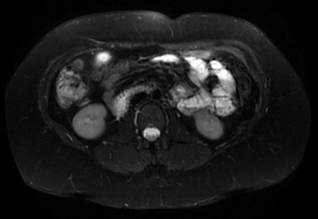 File:Normal liver MRI with Gadolinium (Radiopaedia 58913-66163 Axial T2 fat sat 14).jpg