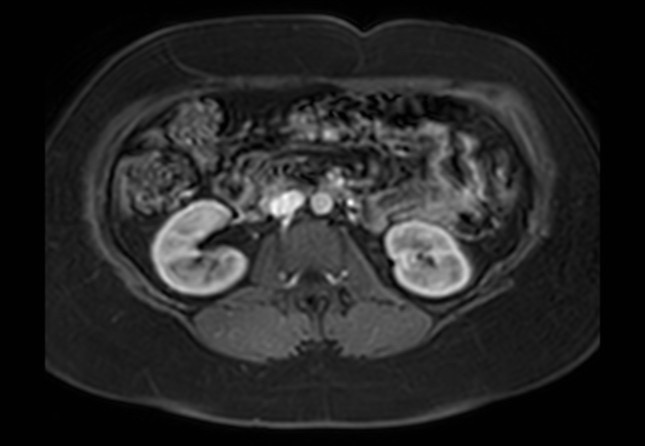 Normal liver MRI with Gadolinium (Radiopaedia 58913-66163 J 15).jpg