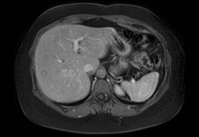 Normal liver MRI with Gadolinium (Radiopaedia 58913-66163 J 53).jpg
