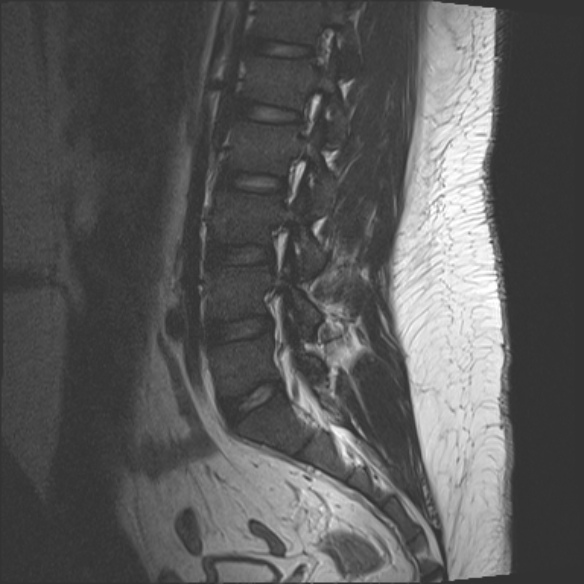 File:Normal lumbar spine MRI (Radiopaedia 47857-52609 Sagittal T2 7).jpg