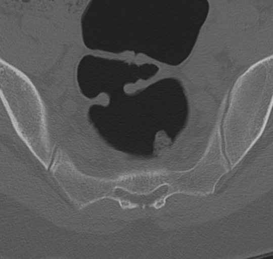 File:Normal lumbosacral CT (Radiopaedia 37923-39867 Axial bone window 95).png