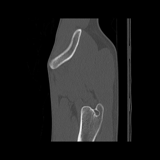 Normal pelvis (Radiopaedia 51473-57238 Sagittal bone window 18).jpg