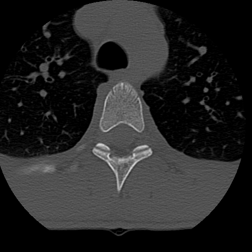 File:Normal trauma spine imaging (age 16) (Radiopaedia 45335-49358 Axial bone window 103).jpg