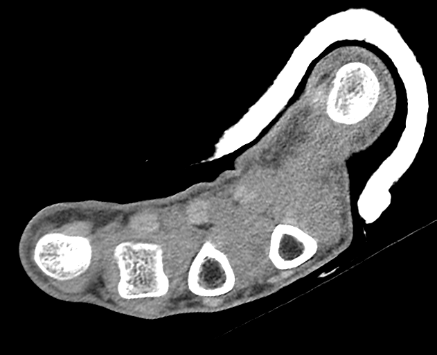 Normal wrist CT (Radiopaedia 41425-44297 Axial non-contrast 8).png