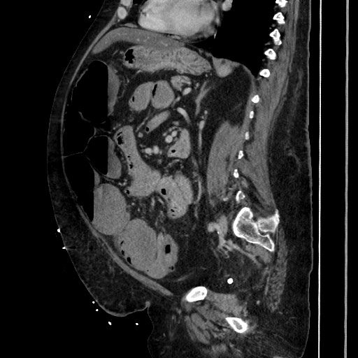 Obstructive colonic diverticular stricture (Radiopaedia 81085-94675 C 142).jpg