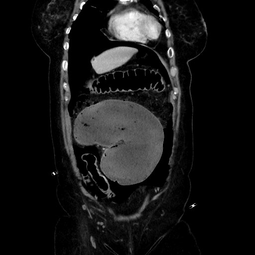Obstructive distal colonic adenocarcinoma causing cecal perforation (Radiopaedia 86830-102989 C 61).jpg