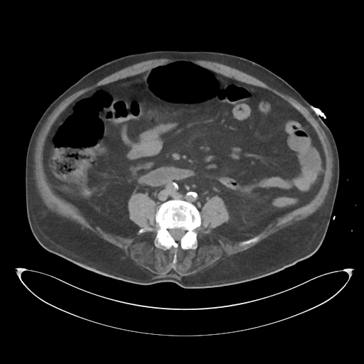 File:Obstructive pyelonephritis (Radiopaedia 46411-50844 Axial non-contrast 47).png