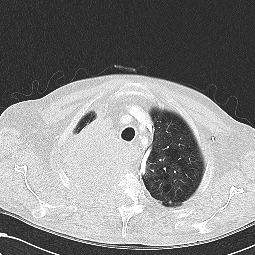 File:Obstructive superior vena cava tumor thrombus (Radiopaedia 28046-28306 Axial lung window 11).jpg