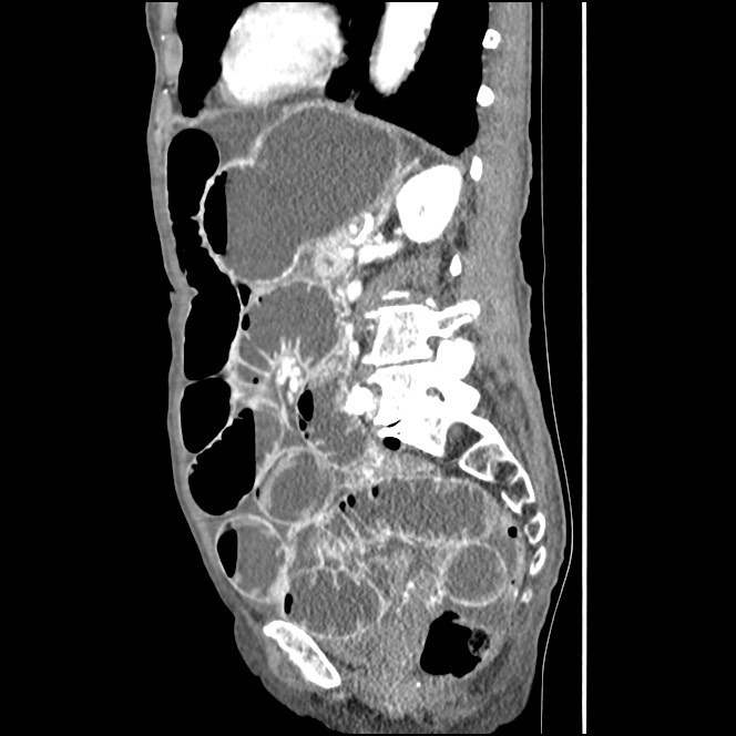 Obturator hernia causing small bowel obstruction (Radiopaedia 65522-74612 C 39).jpg