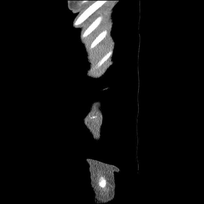 Obturator hernia causing small bowel obstruction (Radiopaedia 65522-74612 C 94).jpg
