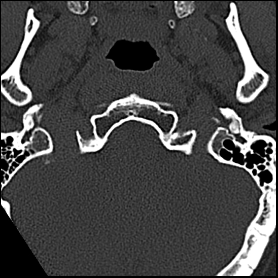 Occipital condyle fracture (type 1) (Radiopaedia 87670-104084 Axial bone window 4).jpg