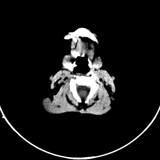 Occipital encephalocele (Radiopaedia 87339-103636 Axial non-contrast 1).jpg