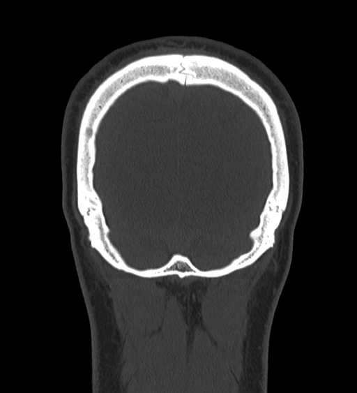 Occipital spur and Currarino type A atlas anomaly (Radiopaedia 87027-103285 Coronal bone window 126).jpg