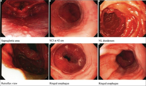Concentric rings in the distal esophagus, consistent with eosinophilic esophagitis