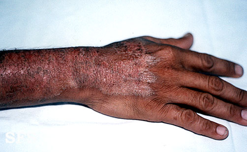 File:Pellagra (Dermatology Atlas 1).jpg