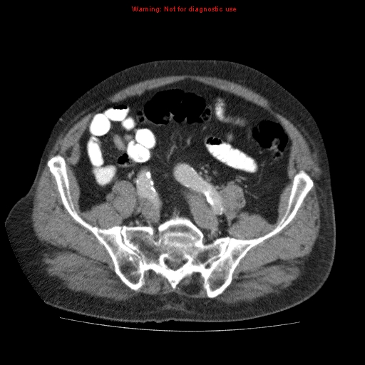File:Abdominal aortic aneurysm (Radiopaedia 10122-10660 Axial C+ portal venous phase 59).jpg