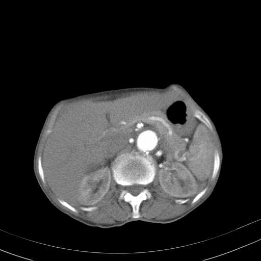 File:Abdominal aortic aneurysm (Radiopaedia 20827-20742 Axial C+ arterial phase 11).jpg