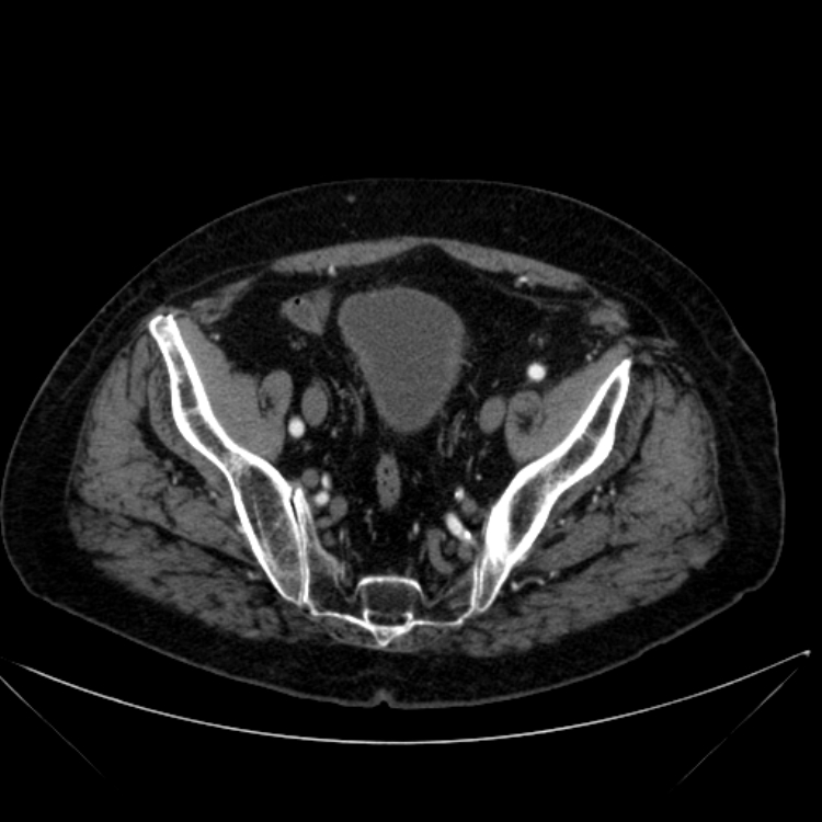 Abdominal aortic aneurysm (Radiopaedia 25855-26001 Axial C+ arterial phase 113).jpg