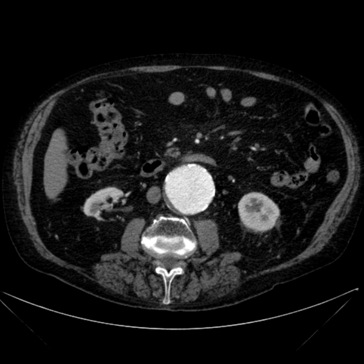 Abdominal aortic aneurysm (Radiopaedia 25855-26001 Axial C+ arterial phase 64).jpg