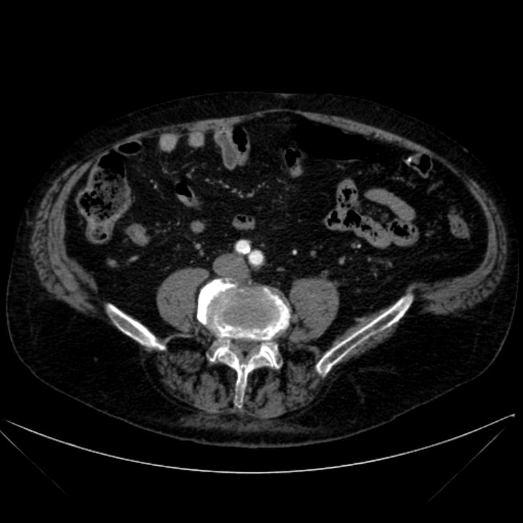 Abdominal aortic aneurysm (Radiopaedia 25855-26001 Axial C+ arterial phase 87).jpg