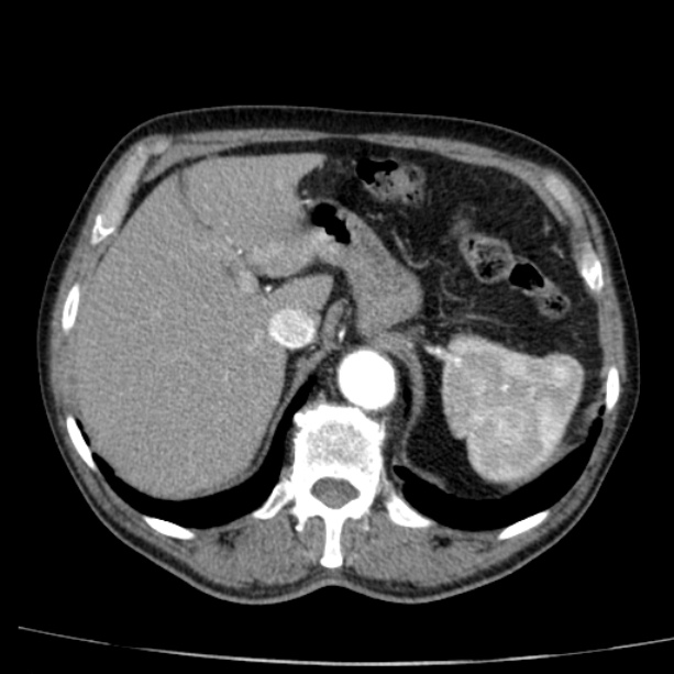 Abdominal aortic aneurysm (Radiopaedia 29248-29660 Axial C+ arterial phase 16).jpg