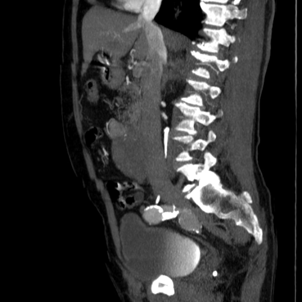 Abdominal aortic aneurysm (Radiopaedia 29248-29660 Sagittal C+ arterial phase 22).jpg