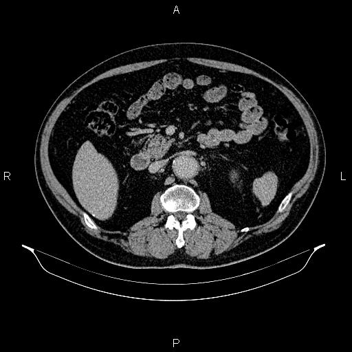 Abdominal aortic aneurysm (Radiopaedia 83094-97462 Axial renal excretory phase 43).jpg