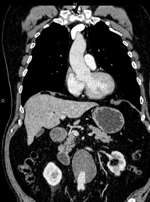 Abdominal aortic aneurysm (Radiopaedia 83094-97462 Coronal renal cortical phase 41).jpg