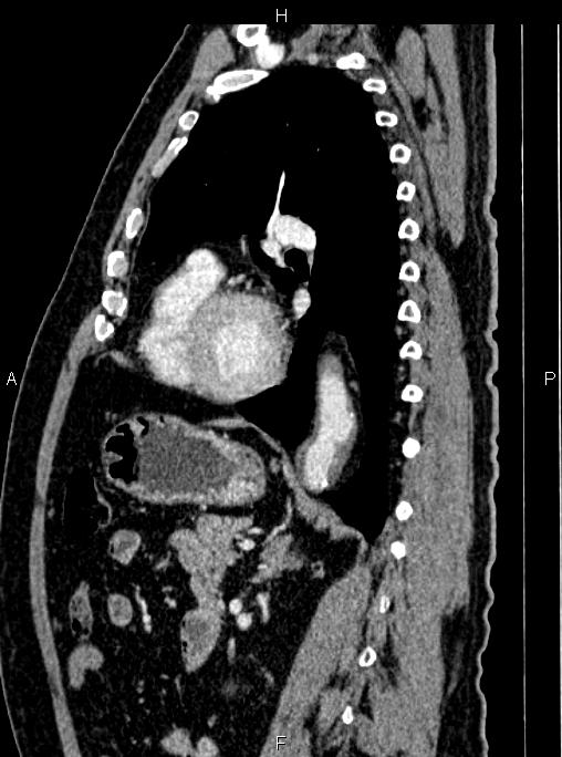Abdominal aortic aneurysm (Radiopaedia 83094-97462 Sagittal renal cortical phase 78).jpg