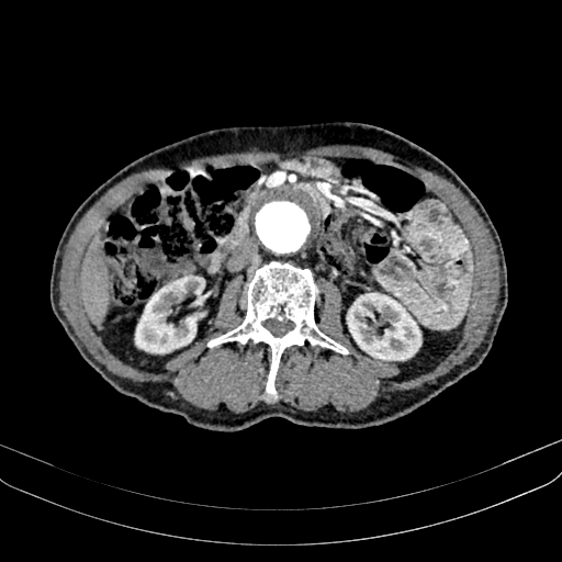 File:Abdominal aortic aneurysm (Radiopaedia 83581-98689 Axial C+ arterial phase 58).jpg