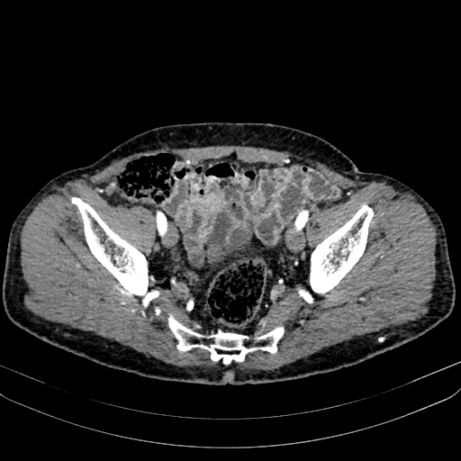 Abdominal aortic aneurysm (Radiopaedia 83581-98689 Axial C+ arterial phase 98).jpg