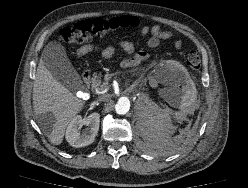 Abdominal aortic aneurysm rupture (Radiopaedia 54179-60362 Axial C+ arterial phase 27).jpg