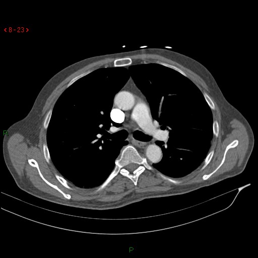 Abdominal aortic aneurysm rupture with aortocaval fistula (Radiopaedia 14897-14841 Axial C+ arterial phase 23).jpg