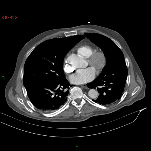Abdominal aortic aneurysm rupture with aortocaval fistula (Radiopaedia 14897-14841 Axial C+ arterial phase 41).jpg