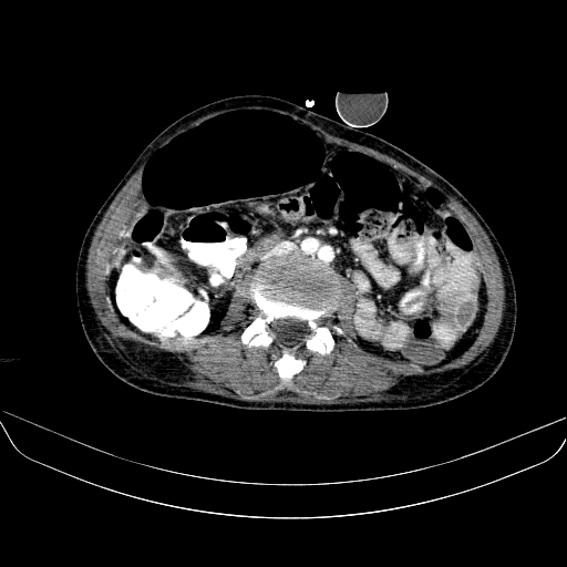 File:Abdominal collection due to previous cecal perforation (Radiopaedia 80831-94320 Axial C+ portal venous phase 111).jpg