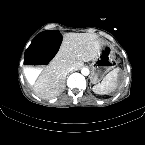 File:Abdominal collection due to previous cecal perforation (Radiopaedia 80831-94320 Axial C+ portal venous phase 38).jpg