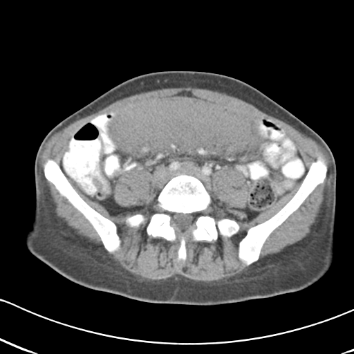 Abdominal desmoid tumor (Radiopaedia 41007-43740 Axial C+ portal venous phase 45).png