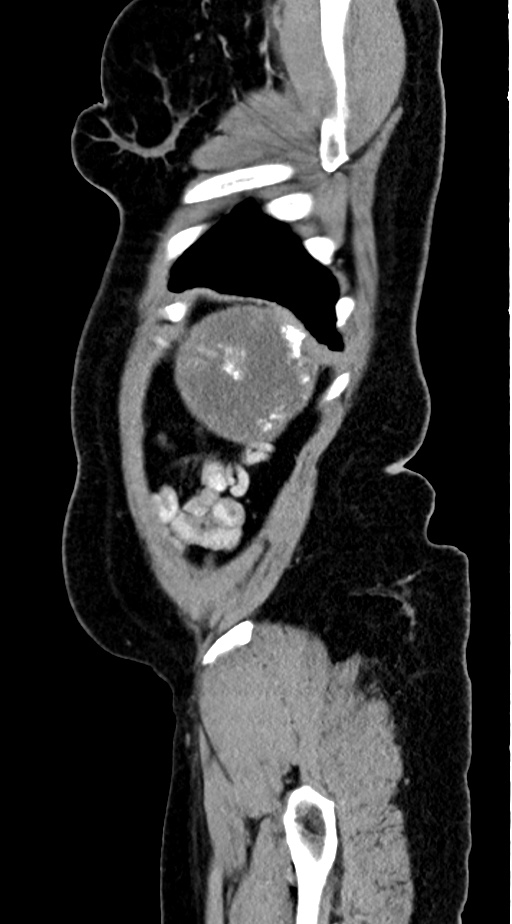 Abdominal hydatid disease (Radiopaedia 68223-77737 Sagittal C+ portal venous phase 5).jpg