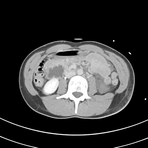 File:Abdominal multi-trauma - devascularised kidney and liver, spleen and pancreatic lacerations (Radiopaedia 34984-36486 Axial C+ delayed 39).png